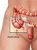 Sntomas de la apendicitis