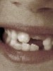 Porque se caen los dientes