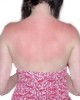 Remedio para las quemadas del sol con aloe vera
