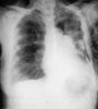 Enfermedad cor pulmonale