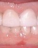 C�mo cuidar las enc�as y evitar la caries