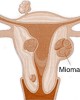 Miomas en el útero