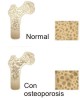 Tratamiento para la osteoporosis