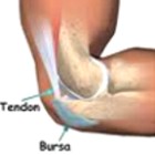 �Se puede hacer ejercicio con bursitis?