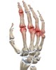 Clases de artritis