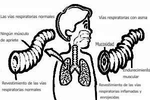 Definici�n de asma bronquial en ni�os