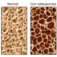 Causas y tratamiento de la osteoporosis