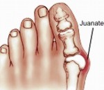 Porque salen los juanetes en los pies que duelen