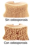 Consejos para prevenir la osteoporosis