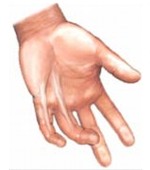 Contractura de Dupuytren