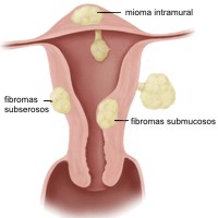 Causa de la miomatosis uterina