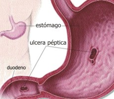 Causa de la lcera pptica