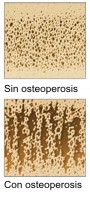 Qué causas puenden provocar osteoporosis