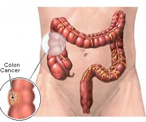 ¿Es hereditario el cáncer de colon?