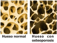C�mo se puede prevenir la osteoporosis