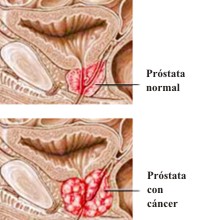 Qu� s�ntomas tiene el c�ncer de pr�stata