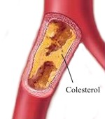 Riesgos del colesterol alto