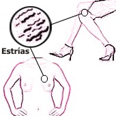 C�mo quitar las estr�as de los senos con remedios caseros