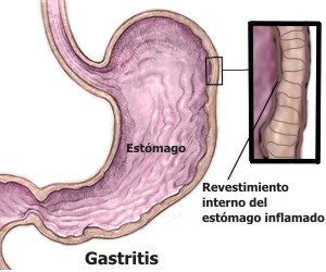 Qué síntomas presenta la gastritis