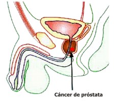 Seales del cncer de prstata