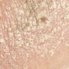 �Se contagia la psoriasis?