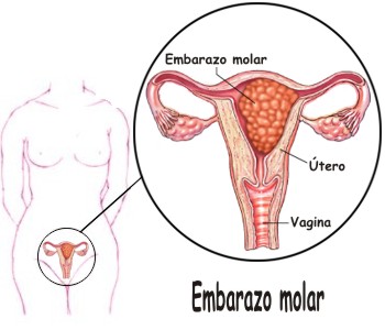 Qué es el embarazo molar