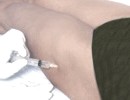 Mesoterapia para combatir la celulitis