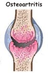 C�mo se diagnostica la osteoartritis