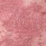 ¿Se cura la psoriasis?