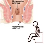 �El estre�imiento es posible causa de hemorroides?