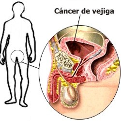 Causas y signos del c�ncer de vejiga