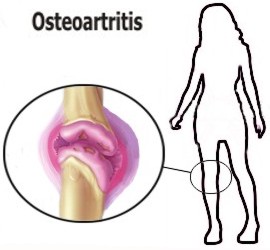 Sntomas de la osteoartritis