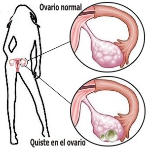�C�mo se forma un quiste en el ovario?
