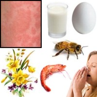 Alergias m�s habituales