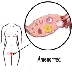 Principales causas de la amenorrea