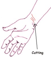 Qué es la enfermedad de cutting