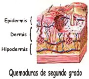 Quemaduras de segundo grado y su tratamiento