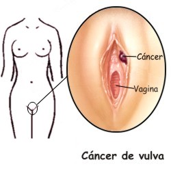 Cu�les son los s�ntomas del c�ncer de vulva