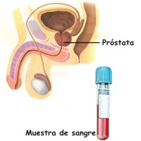 Examen de próstata PSA