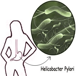 Cuáles son los síntomas de la bacteria Helicobacter Pylori
