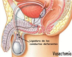 Qué es la vasectomía y en qué consiste