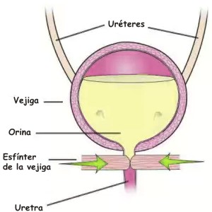 Clases de incontinencia urinaria que hay