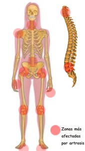 Que partes del cuerpo ataca la artrosis