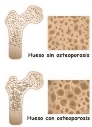Enfermedades de los huesos osteoporosis