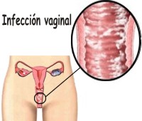 Porque se dan las infecciones vaginales