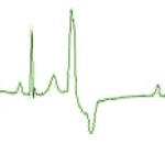 Cuándo se debe tomar un electrocardiograma