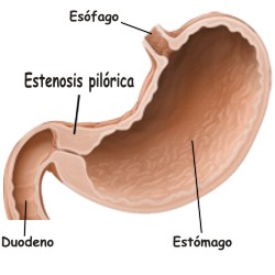 Qué es la estenosis pilórica