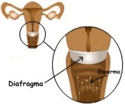 �Cu�ndo sustituir el diafragma anticonceptivo?