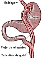 Lo bueno y lo malo del bypass g�strico