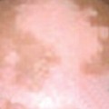 Diferencia entre mal de pinto y vit�ligo